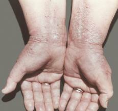 Allergy on hands photo