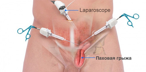 Laparoskopisk kirurgi