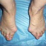 Métodos de tratamento do pé plano transversal