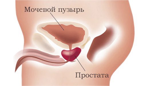 Disease in men: prostate cyst