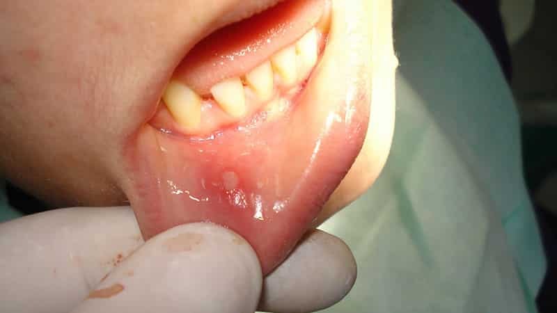 Białe owrzodzenia w jamie ustnej