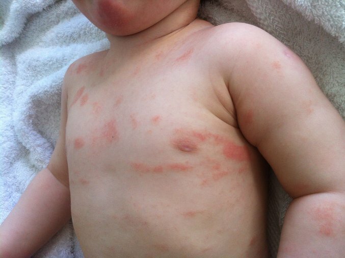 23054-psoriasis-u-children-causes-and-treatment-photo