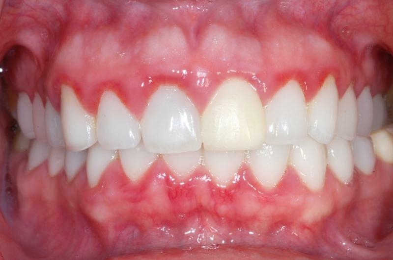Kronisk bluetongue tandkødsbetændelse: Picture, symptomer og behandling