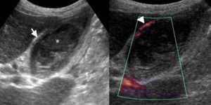Slokdarmcholecystitis