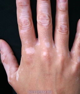 Eliminación láser de vitiligo