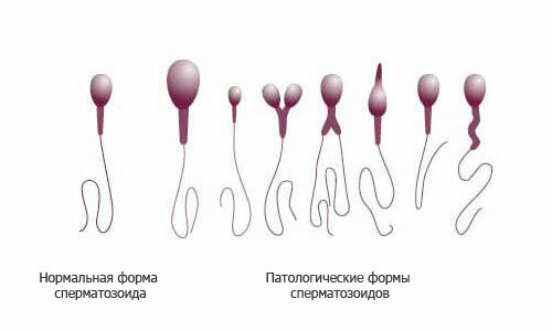 Normalnog i patološkog-form-sperme( 1)