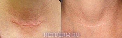 The procedure for the removal of scars and laser results
