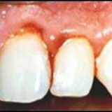 Causes of bleeding gums
