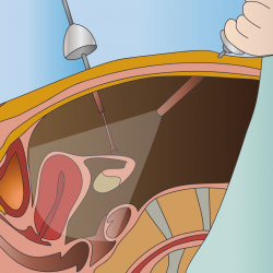 Contraindicaciones para la cirugía laparoscópica