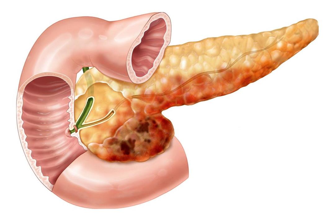 Necrose pancreática: o que é, tipos, sintomas e tratamento