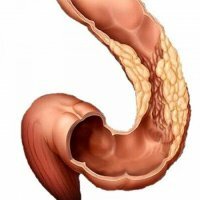 Symptoms of bowel cancer