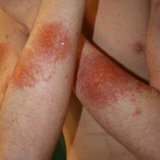 Allergische contactdermatitis