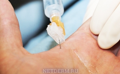 Anesthesia before laser removal of moles