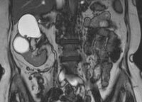 Imagen de resonancia magnética de la tuberculosis renal