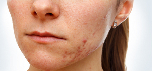 Hoe zich te ontdoen van de post-acne
