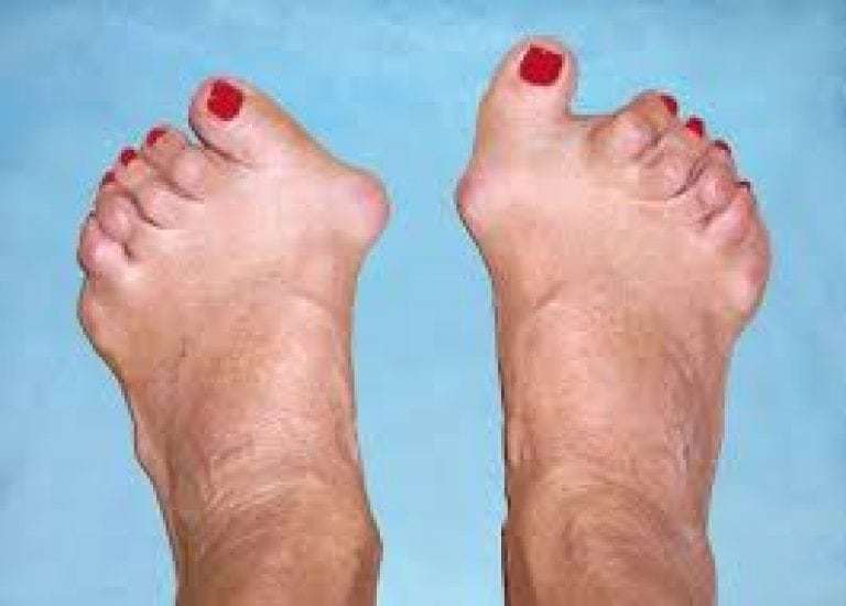 Why does the joint of the big toe hurt? Causes, treatment