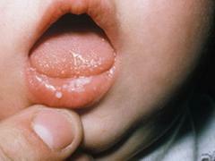 Oral candidiasis hos nyfødte: årsager