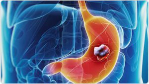 Oncologie van de maag