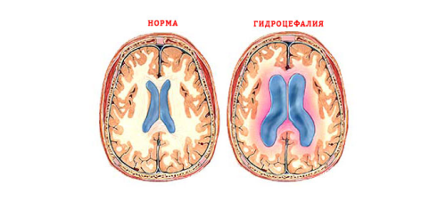 Pitovanie mozgu: príznaky, diagnostika a liečba