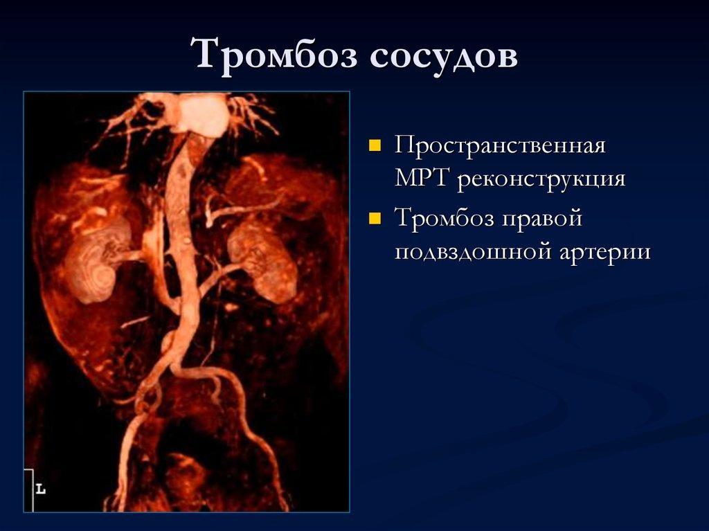 MRI performed with a contrast agent allows you to determine the pathology of blood vessels, arteries and veins