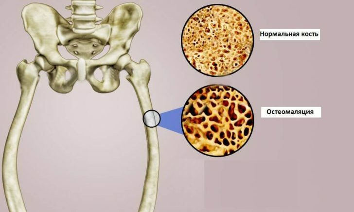 osteomalacie