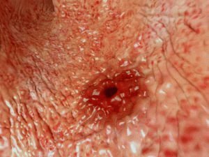 Terugkeer van ulceratieve pathologie