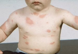 Urticaria en la piel