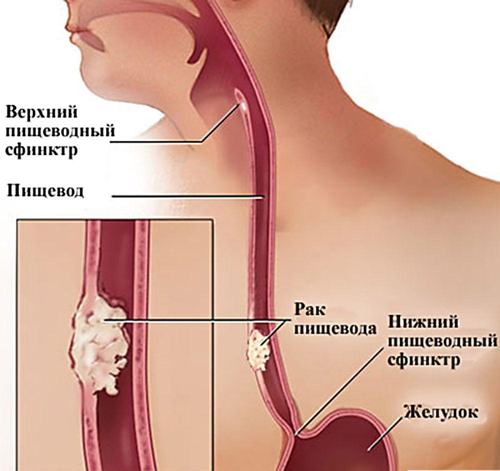 Tumor do esôfago: sintomas