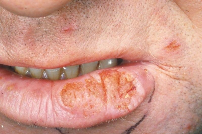 bibir kanker tahap awal: foto, gejala dan tanda-tanda