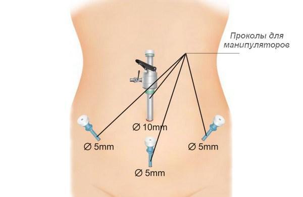 Cirurgia laparoscópica 