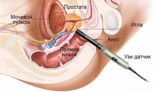 How is prostate biopsy performed?