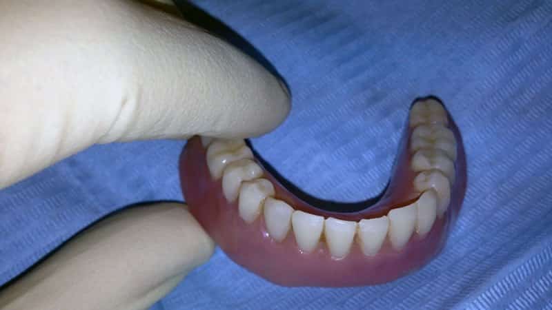Acrylic dentures: what is it, pros and cons, photo