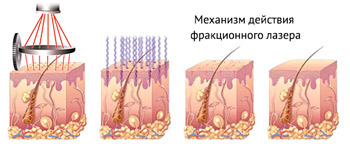 Mechanism of action of laser fractional facial rejuvenation