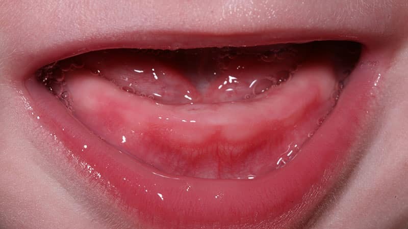 Dobivanje zuba u djece