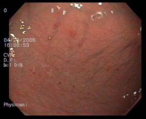 Gastritis aguda