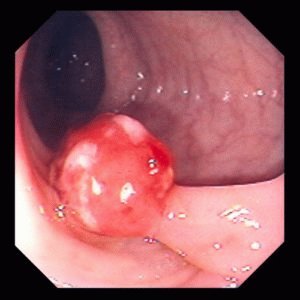 Poliepen in het rectum: oorzaken, symptomen en behandeling zonder operatie