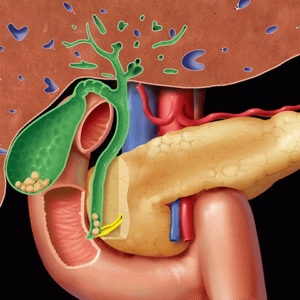 cholelithiasis