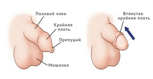 Die Beschneidung bei erwachsenen Männern: In einigen Fällen illustriert