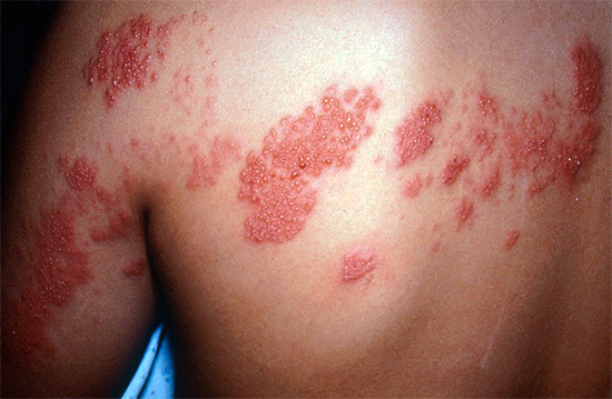 Symptoms of herpes simplex type 3
