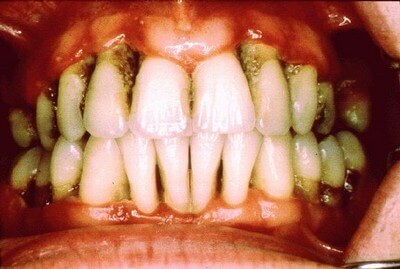 Chronische parodontitis