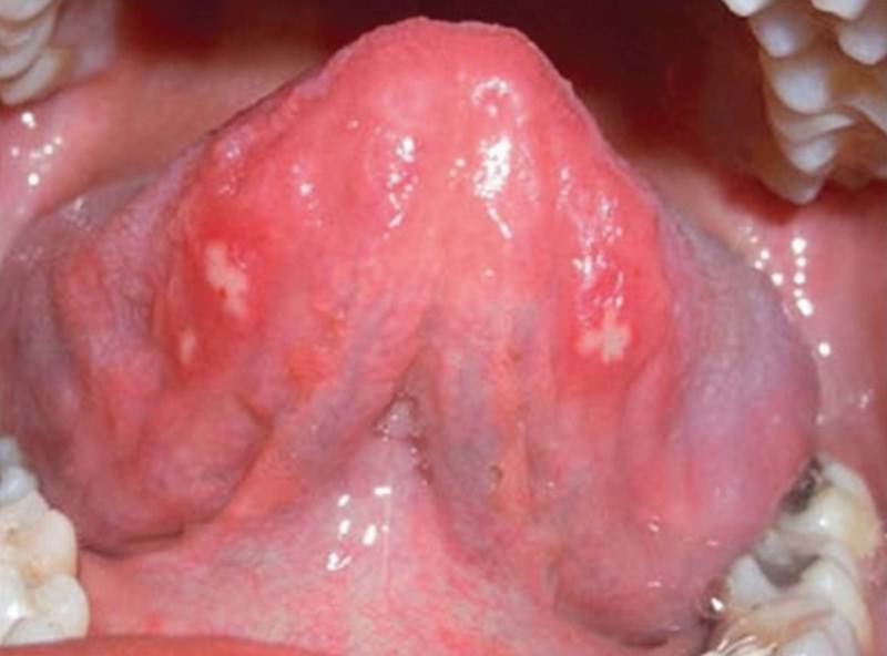Może to być zapalenie jamy ustnej w leczeniu dorosłych języka