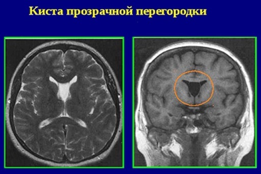 Cyste van een transparante septum van de hersenen