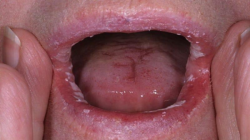 Zašto na usnama pojaviti bijele mrlje u jutarnjim satima