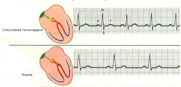 sinustachycardie-1