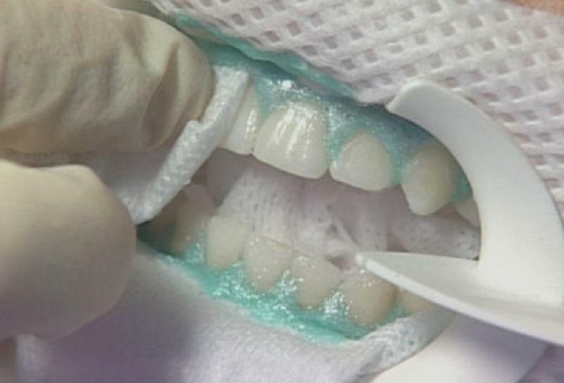 отбеливание зубов кальция глюконатом