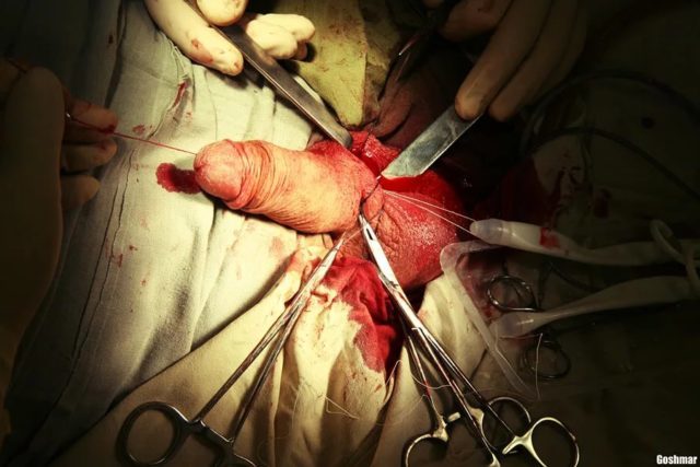 Quirúrgico extensión del pene