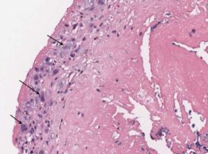 Bakteriális endocarditis