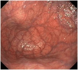 Atrofični gastritis: simptomi i liječenje