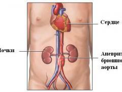 Atherosclerosis of the abdominal aorta, symptoms, diagnosis, treatment