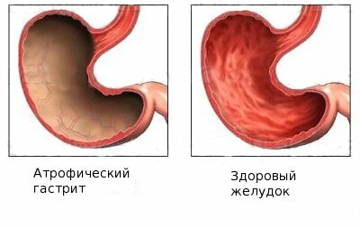 Faze zdravljenja kroničnega atrofičnega gastritisa